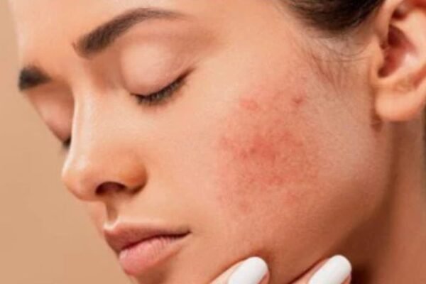 Cleanse and Moisturise Your Face Every Day If You Suffer From Severe Acne or Pimples