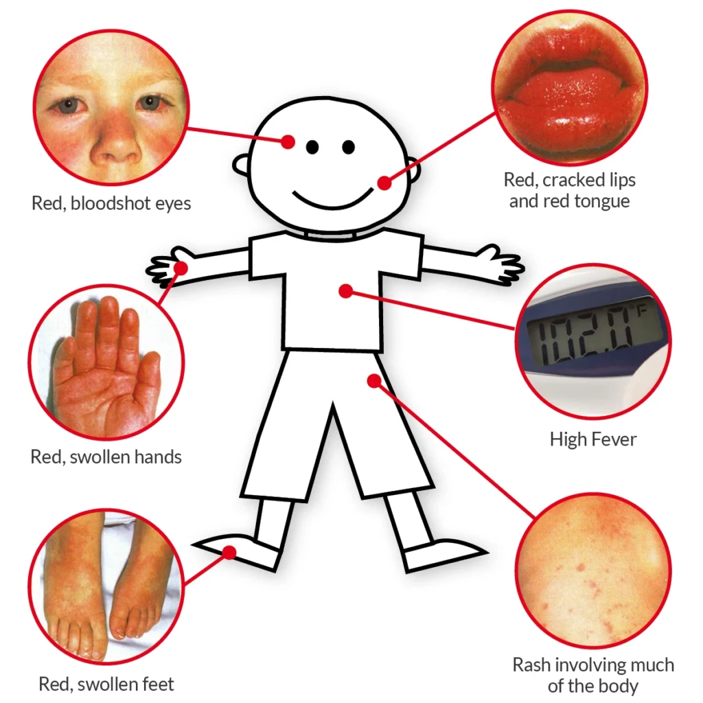 Symptoms Kawasaki Disease